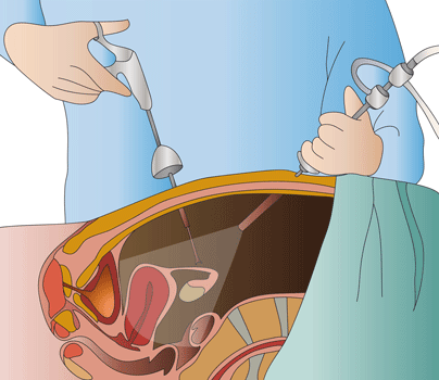 Laparoscopy