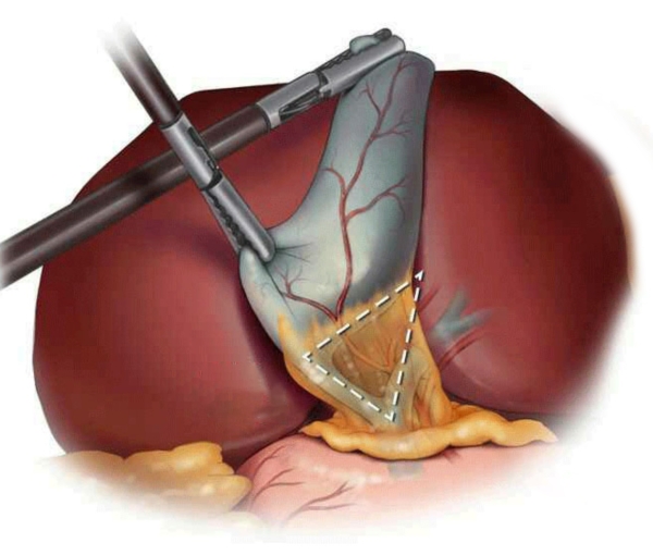 Gallbladder surgery