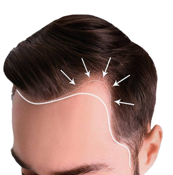 Implante de cabello FUE