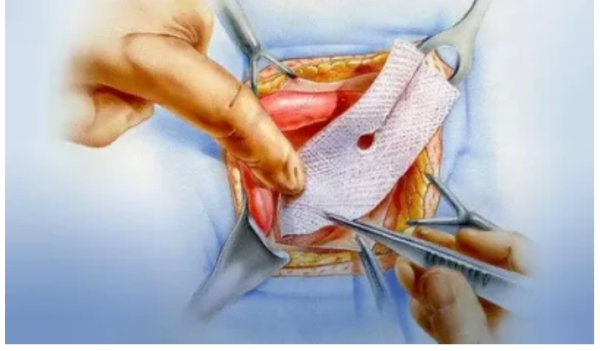 Hernia inguinal