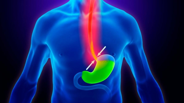 nissen fundoplication