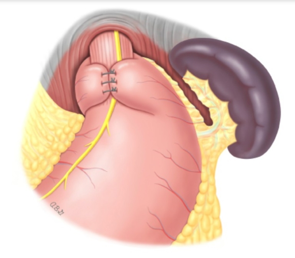 Nissen fundoplication